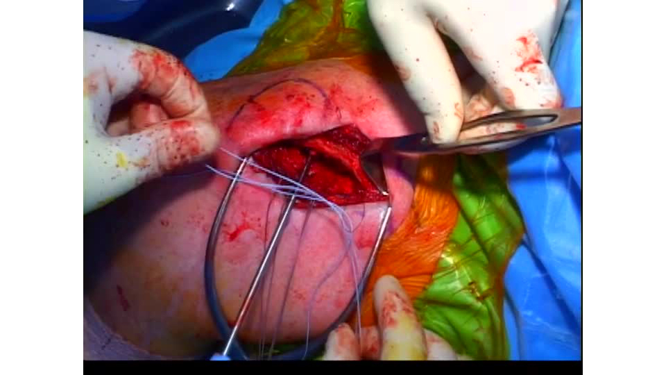 Anatomic Coracoclavicular Ligament Reconstruction for the Treatment of Chronic AC Joint Separations Featuring the Bio-Tenodesis™ System