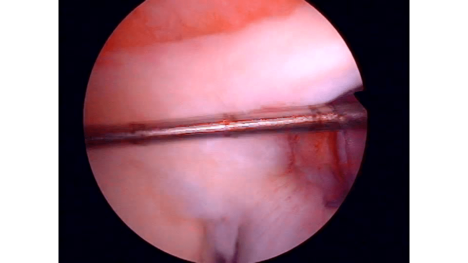 Anterior Portal, Biceps Evaluation and Peel-Back Test