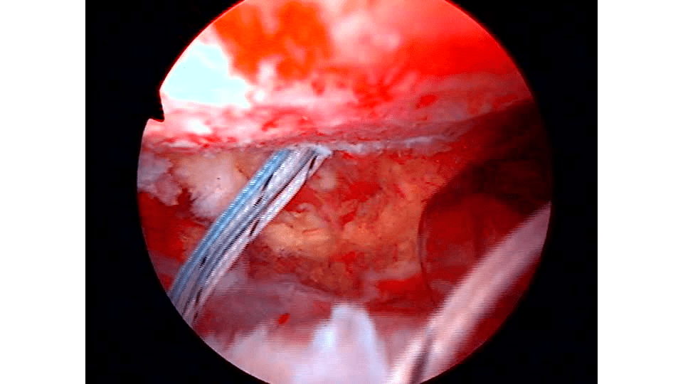 Double Pulley Trans-Tendon PASTA Repair Using Bio-Corkscrew® FT Anchors