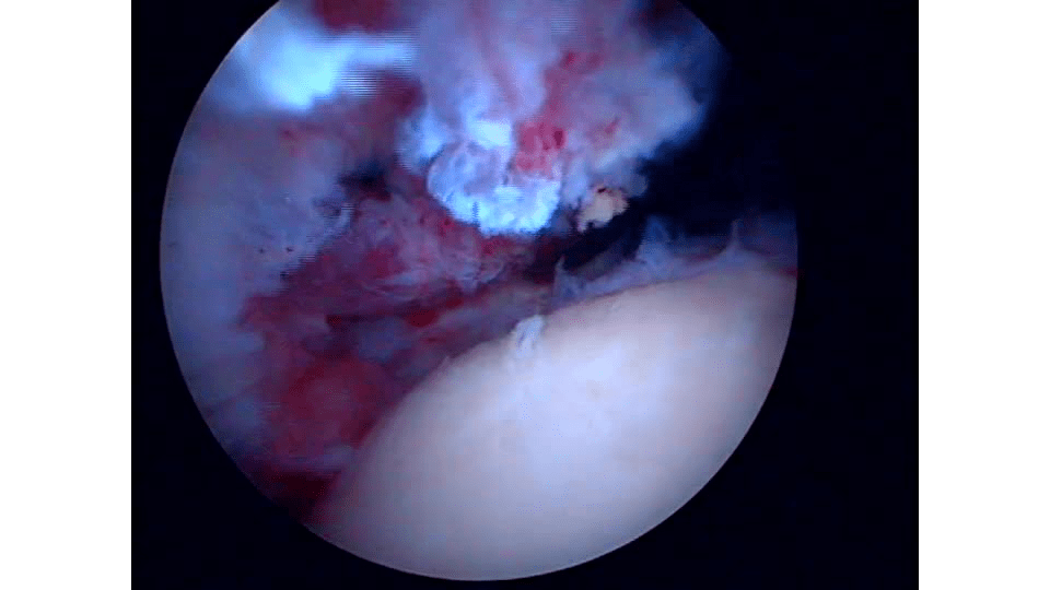 Subscapularis Repair Using The Bio-Corkscrew® FT Anchor