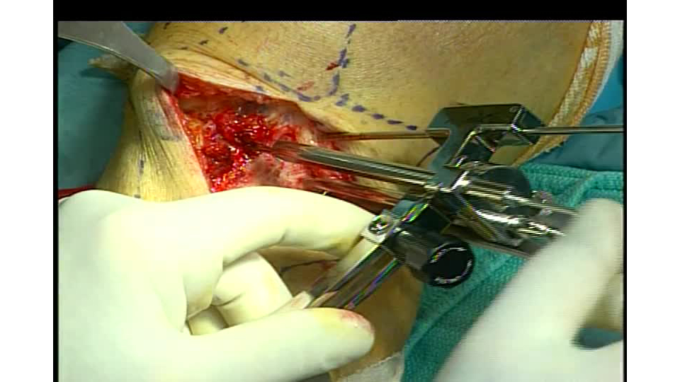 Proximal Tibial Opening Wedge Osteotomy