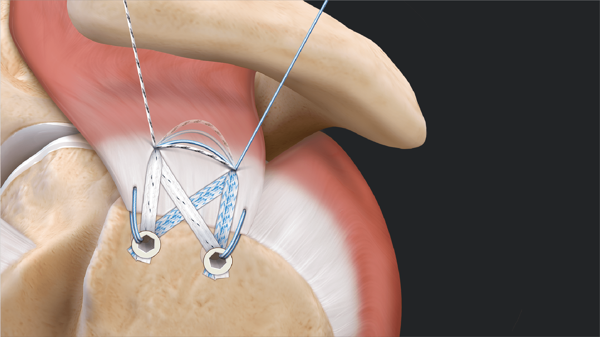 SpeedBridge™ Rotator Cuff Repair Using Tensionable Knotless SwiveLock® Anchors