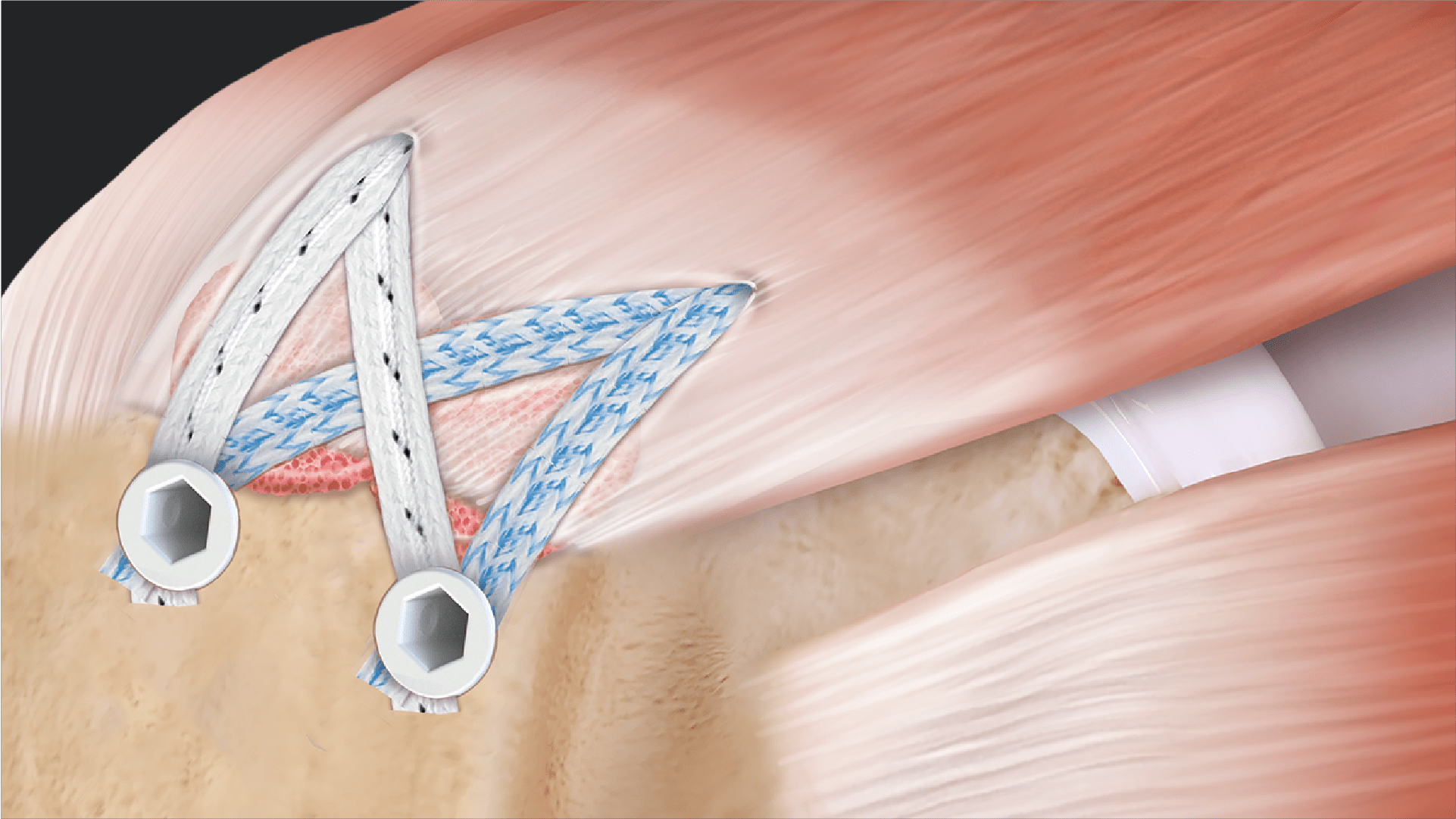 SpeedBridge™ Rotator Cuff Repair With Knotless SwiveLock® Anchors and AlloSync™ Buttons