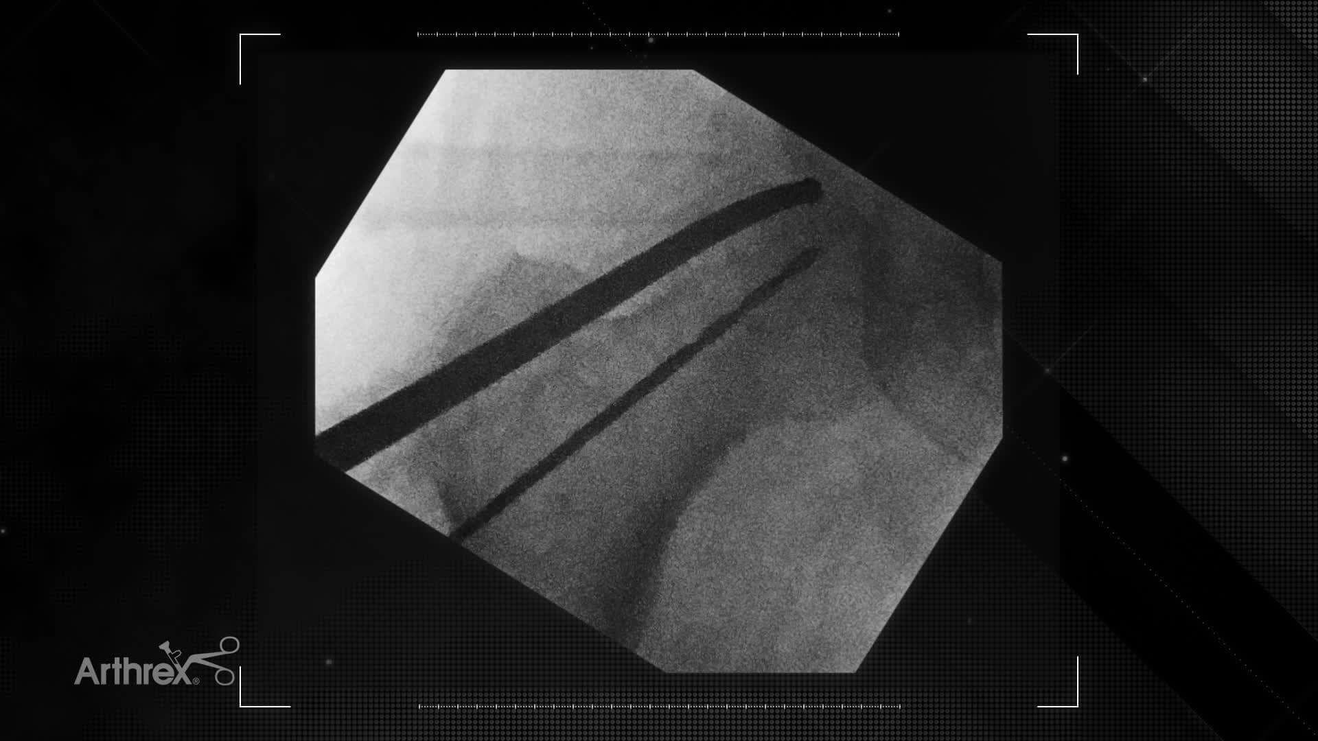 Arthroscopically Assisted Core Decompression of the Hip for Avascular Necrosis of the Femoral Head