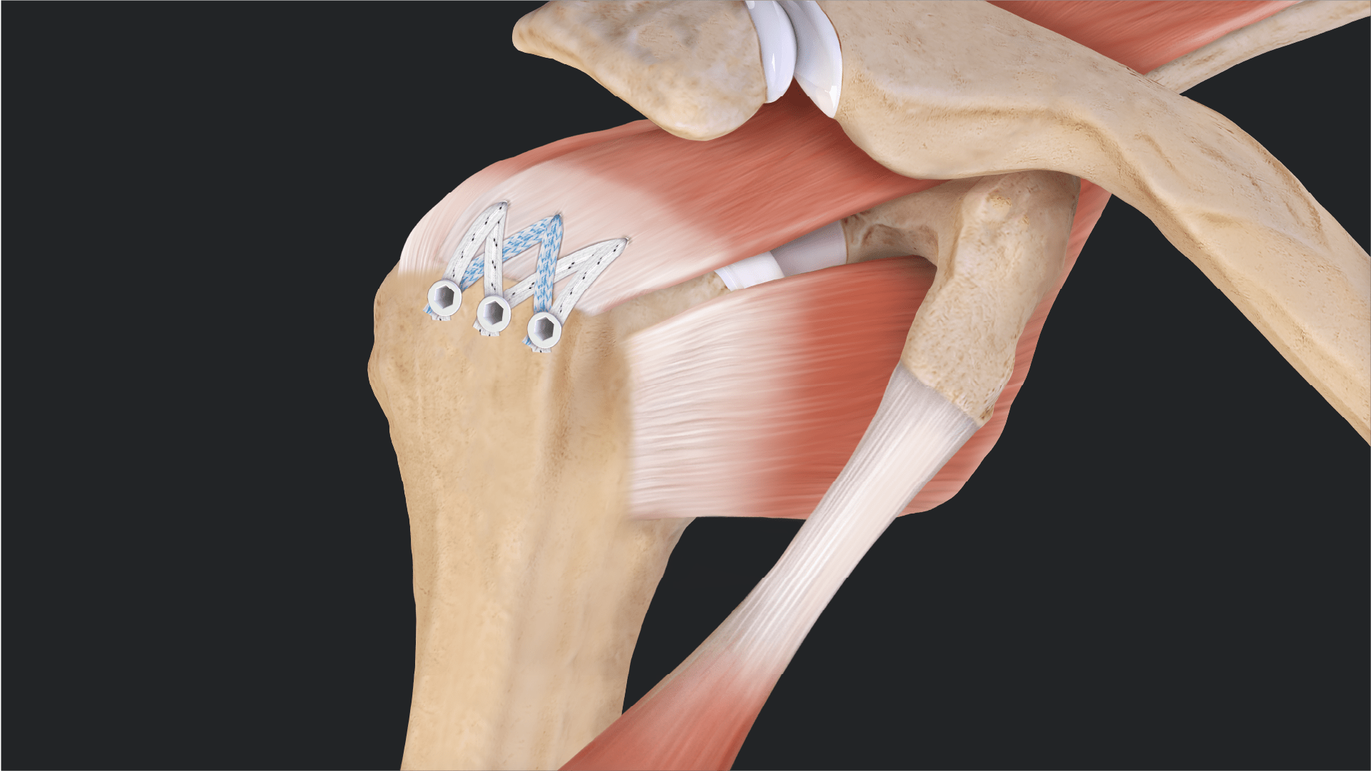 Expansion SpeedBridge™ Repair for Massive Rotator Cuff Tear