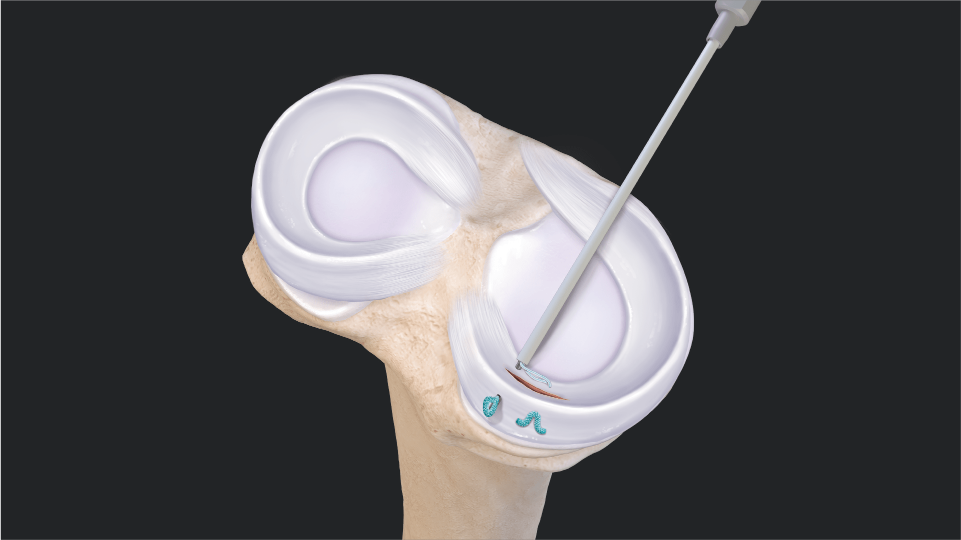 FiberStitch™ Implant All-Inside Meniscus Repair