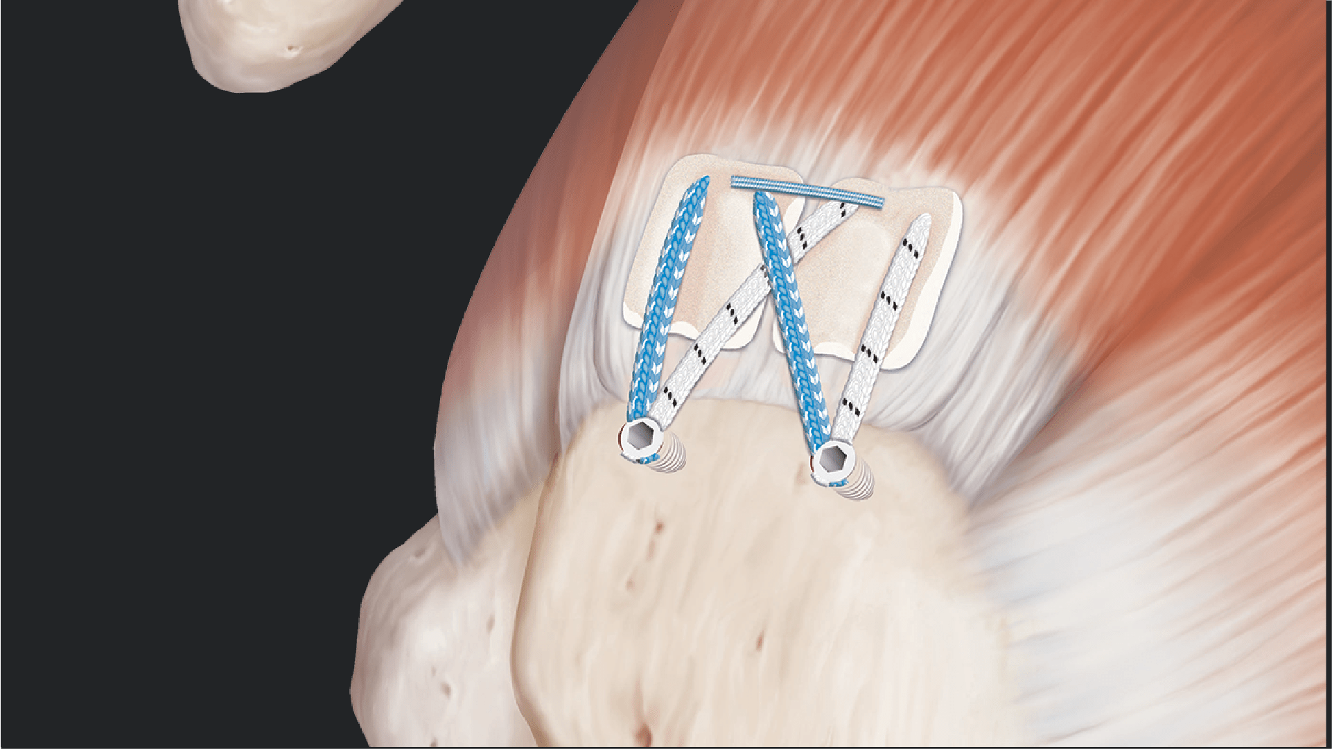 RCR Repair Using the Knotless SwiveLock® Anchor and ArthroFLEX® BioWasher® Decellularized Dermis