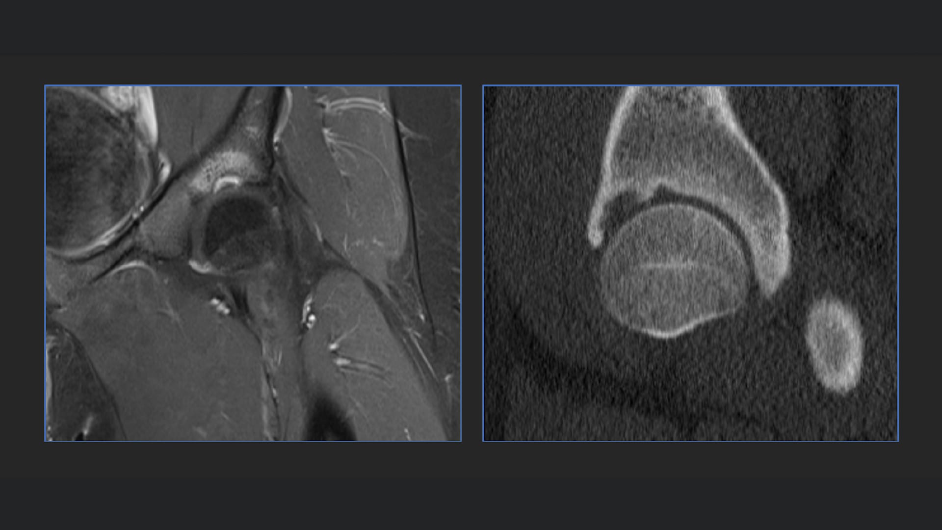 Biologic Repair of Acetabular Cyst Using the IntraOsseous BioPlasty System and AutoCart™ Procedure