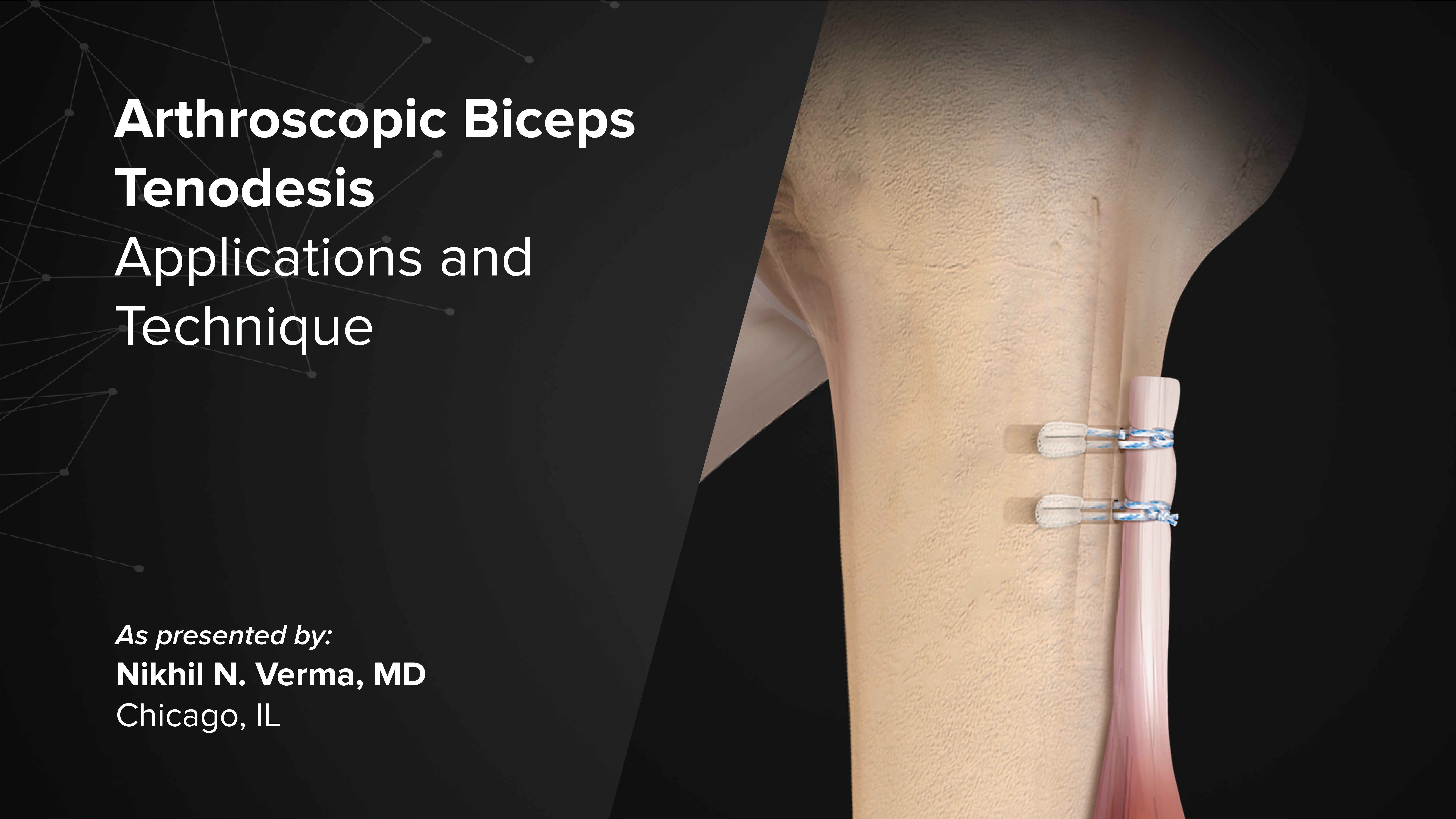 Arthroscopic Biceps Tenodesis: Applications and Technique