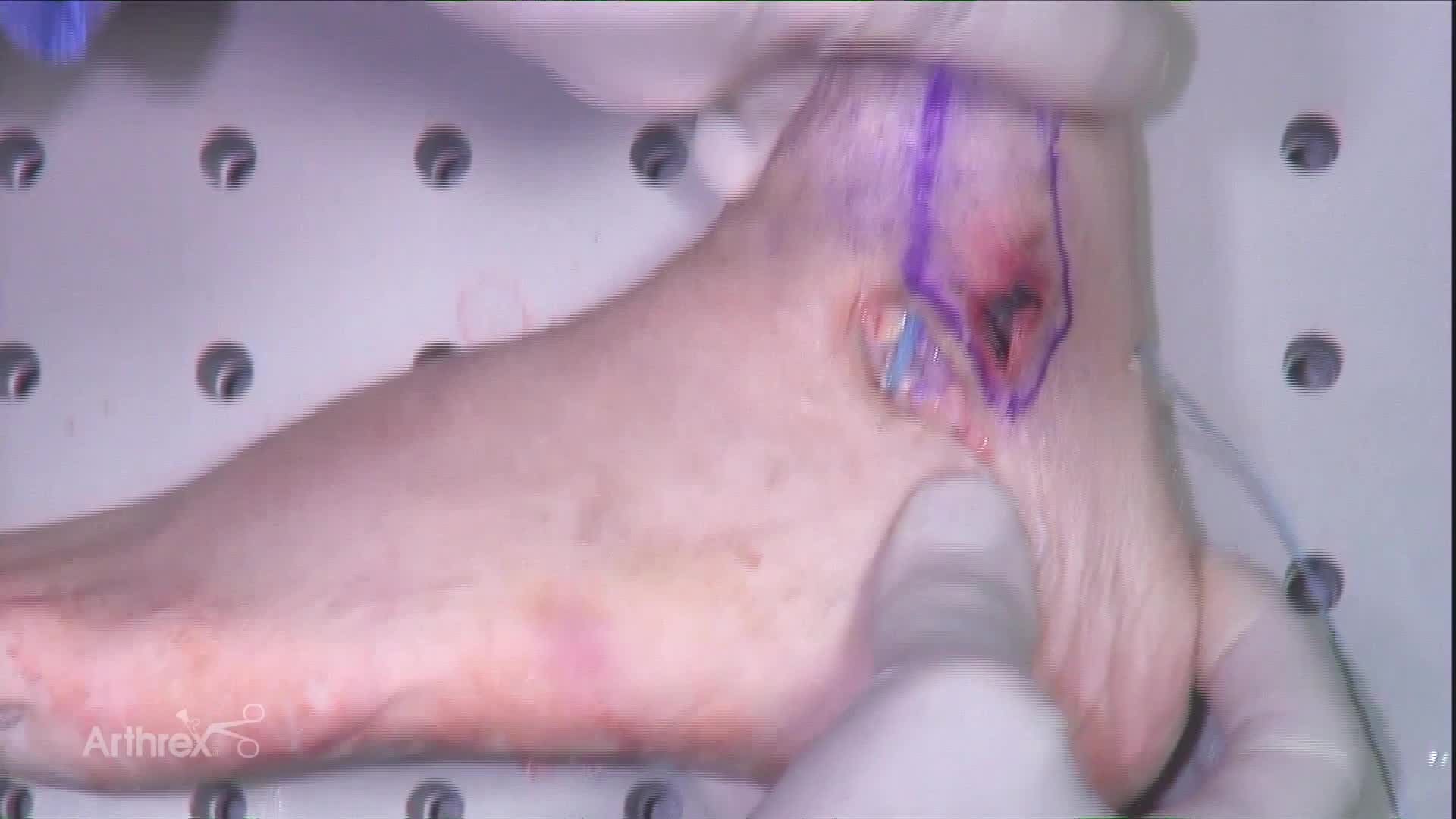 Brostrom and Achilles Tendon Repair With InternalBrace™ Ligament Augmentation Repair