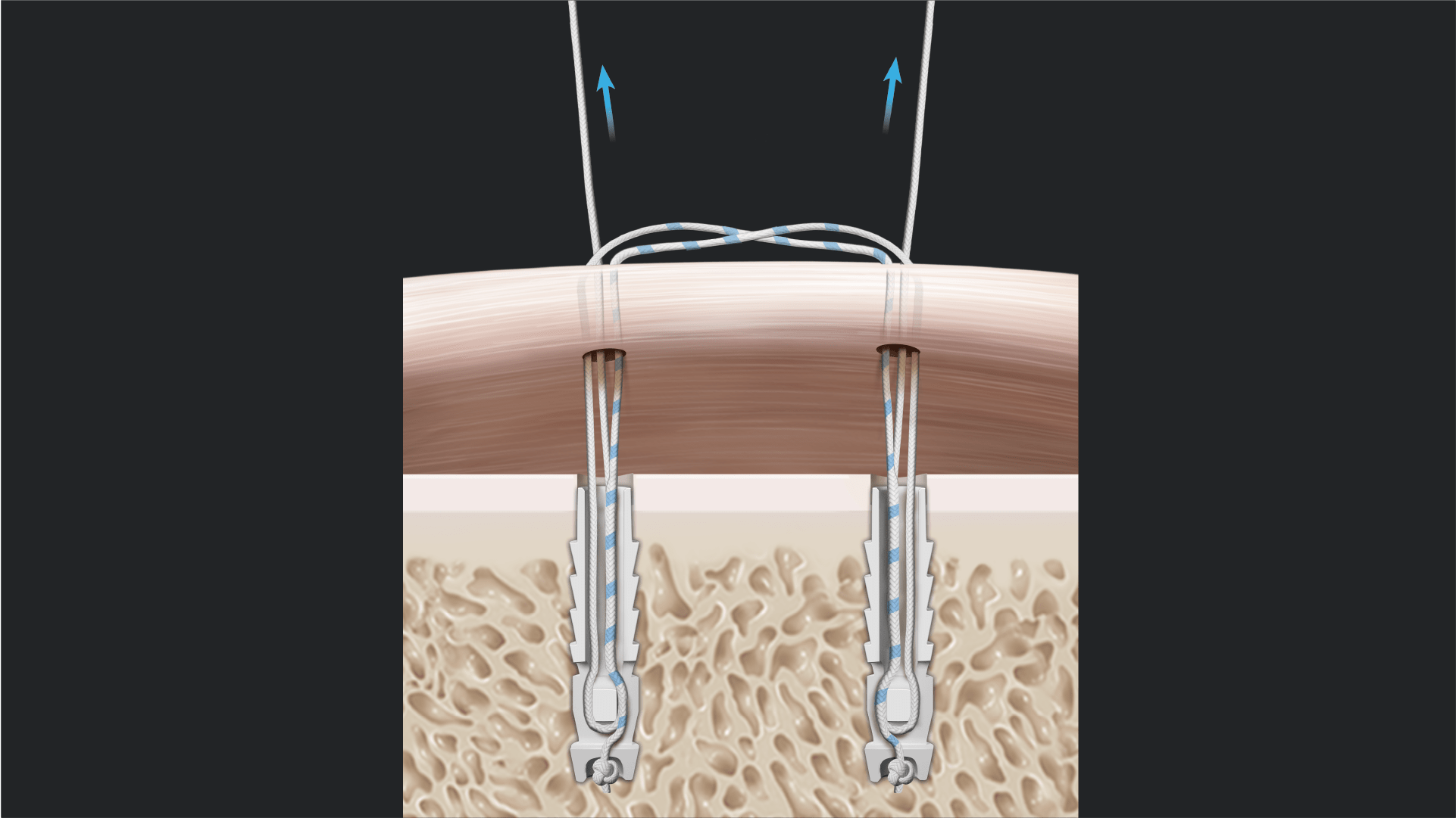 Complex Instability Repair Using Tensionable Knotless Technology