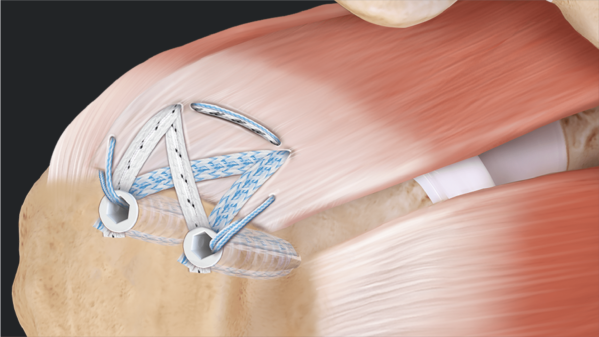 SpeedBridge™ Repair With Knotless Medial Pulley