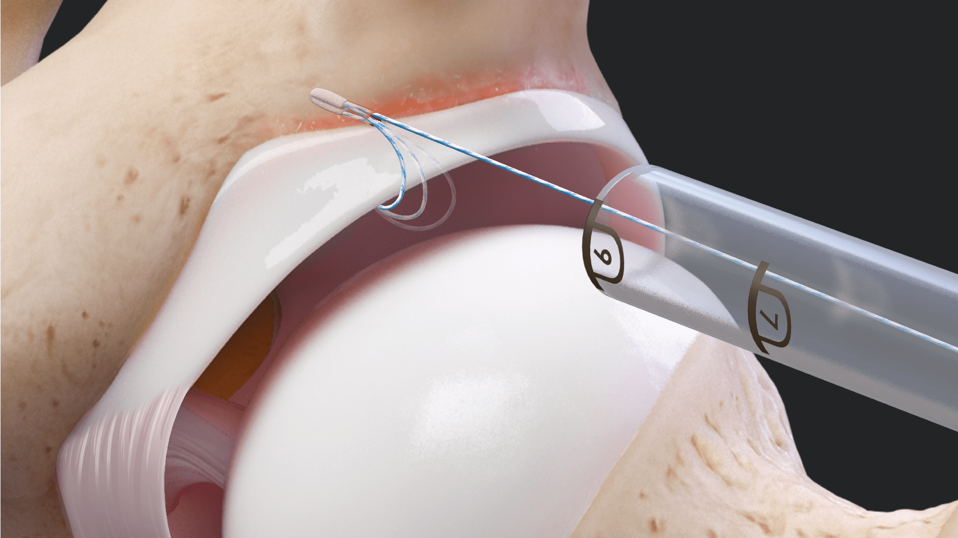 Revision Acetabular Labral Repair Using the Knotless Hip FiberTak® Soft Anchor