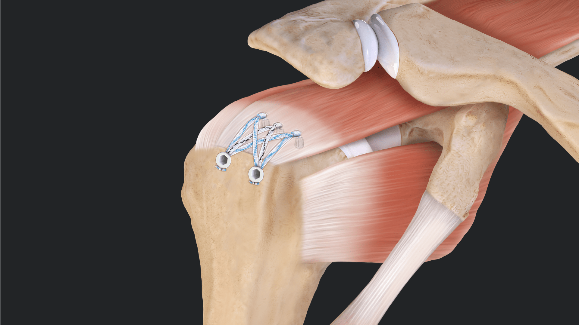 SutureBridge™ Repair With Self-Punching 2.6 FiberTak® and Knotless SwiveLock® Anchors