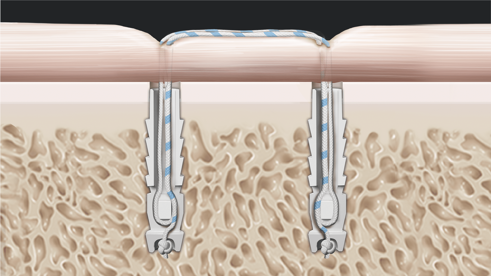 Bony Bankart Repair Using Tensionable Knotless Technology