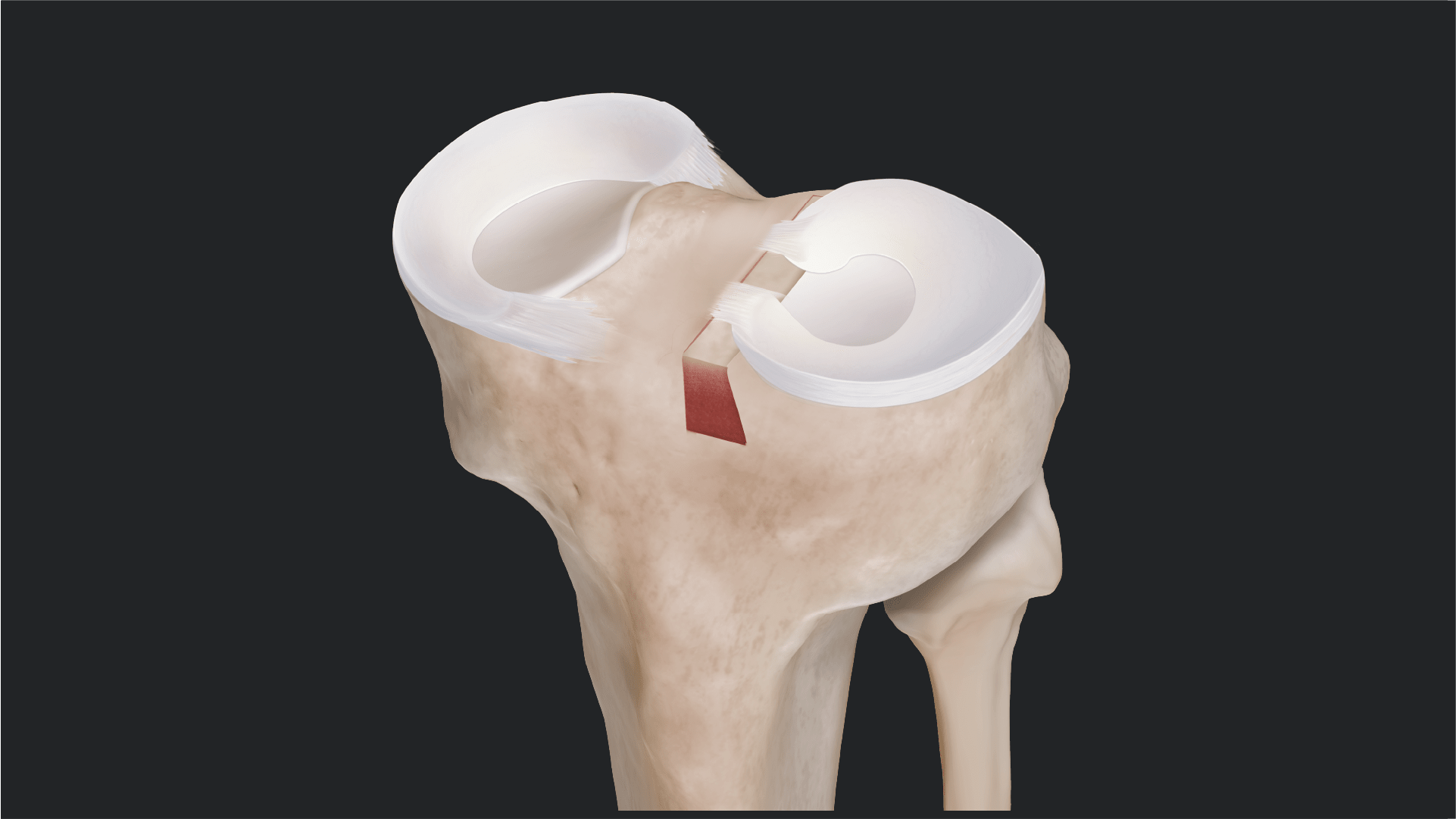 Meniscus Transplantation: 20-Year Survivorship and Outcomes