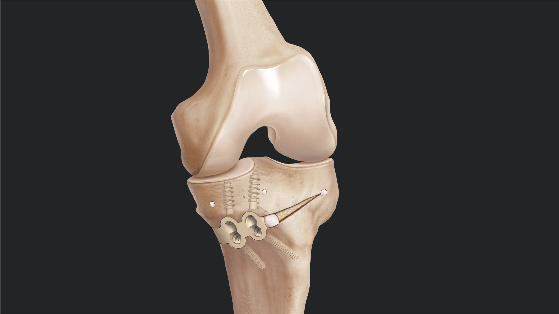 HTO Using the iBalance® Osteotomy System