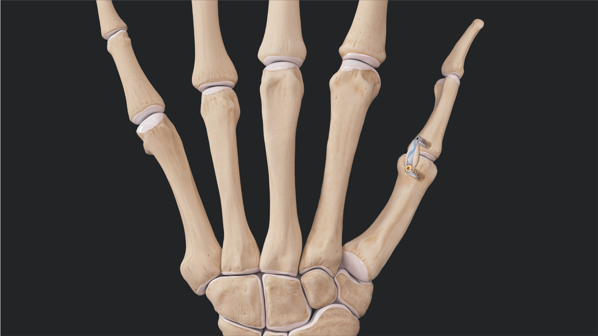 Thumb UCL Repair With InternalBrace™ Ligament Augmentation Using the Nano and DX SwiveLock® SL Anchors