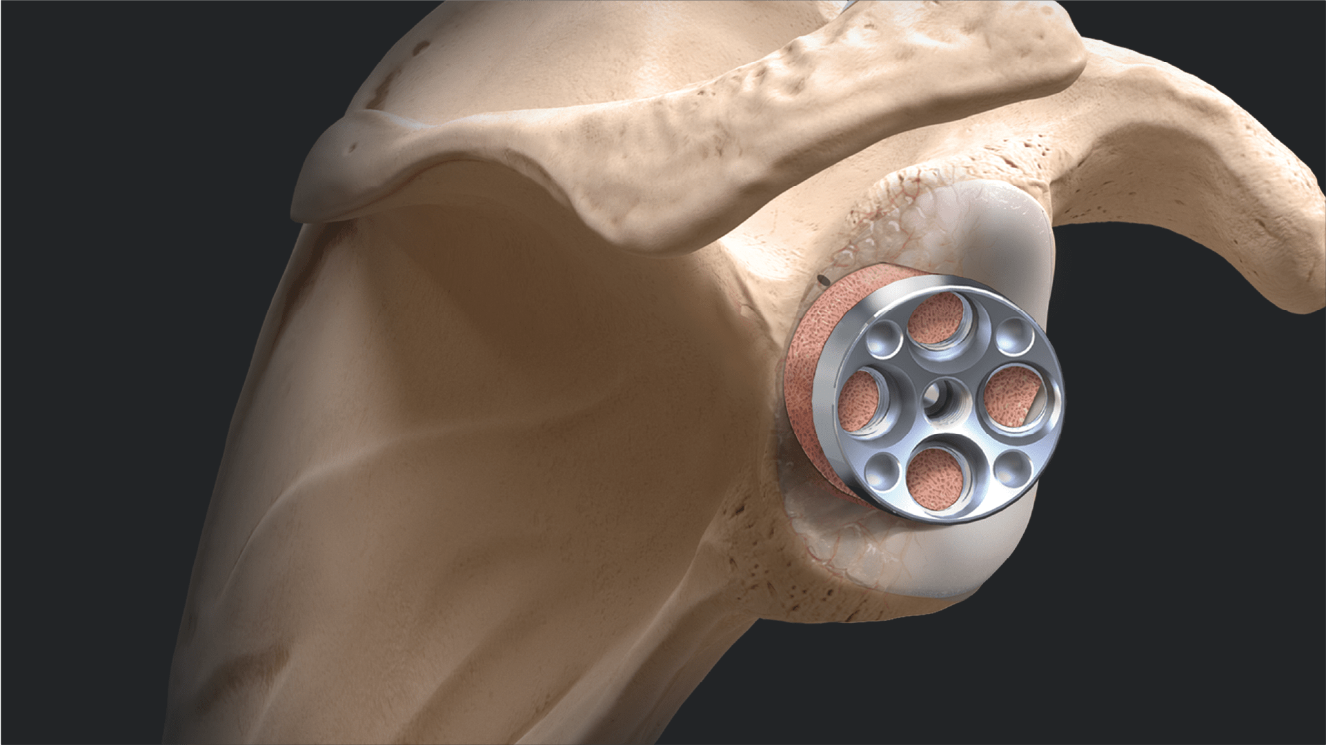 Modular Glenoid System (MGS) Bone Graft Instrumentation