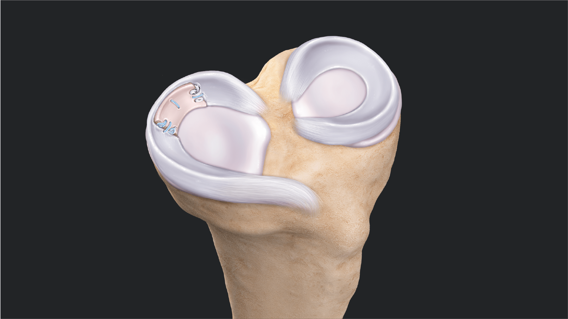 Segmental Meniscus Allograft Transplantation for a Focal Meniscal Deficiency