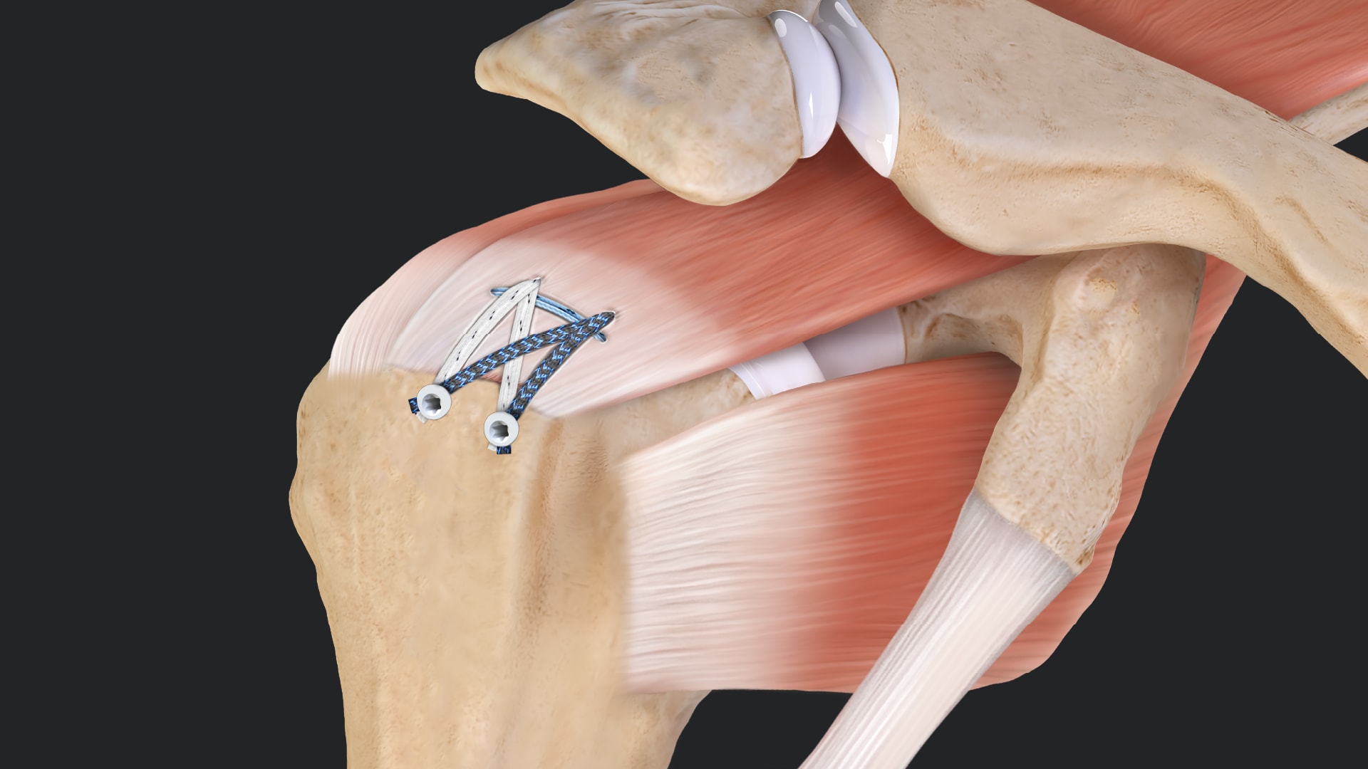Arthrex - FiberTak® SpeedBridge™ Repair for Small Rotator