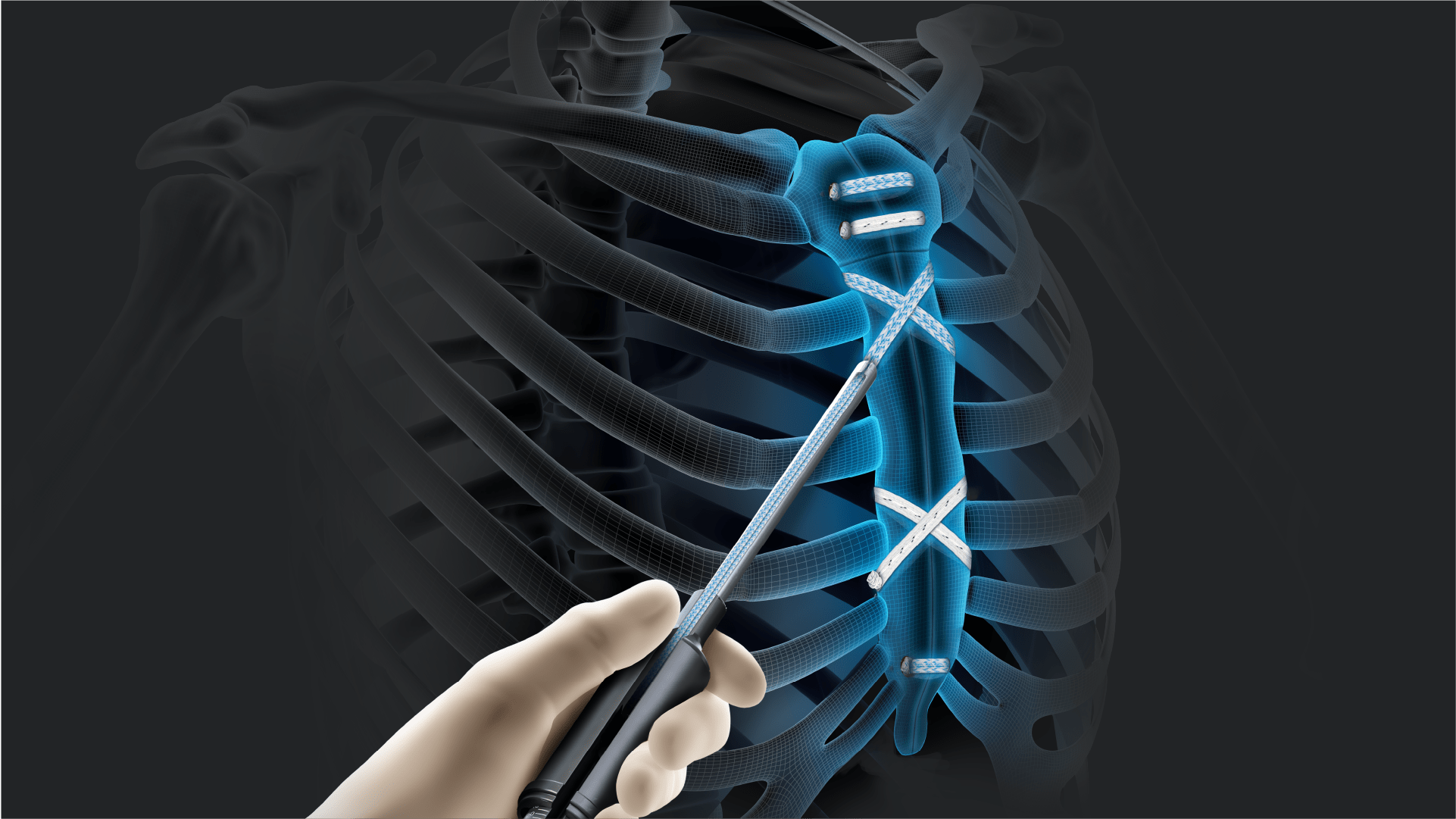 FiberTape® Sternal Closure