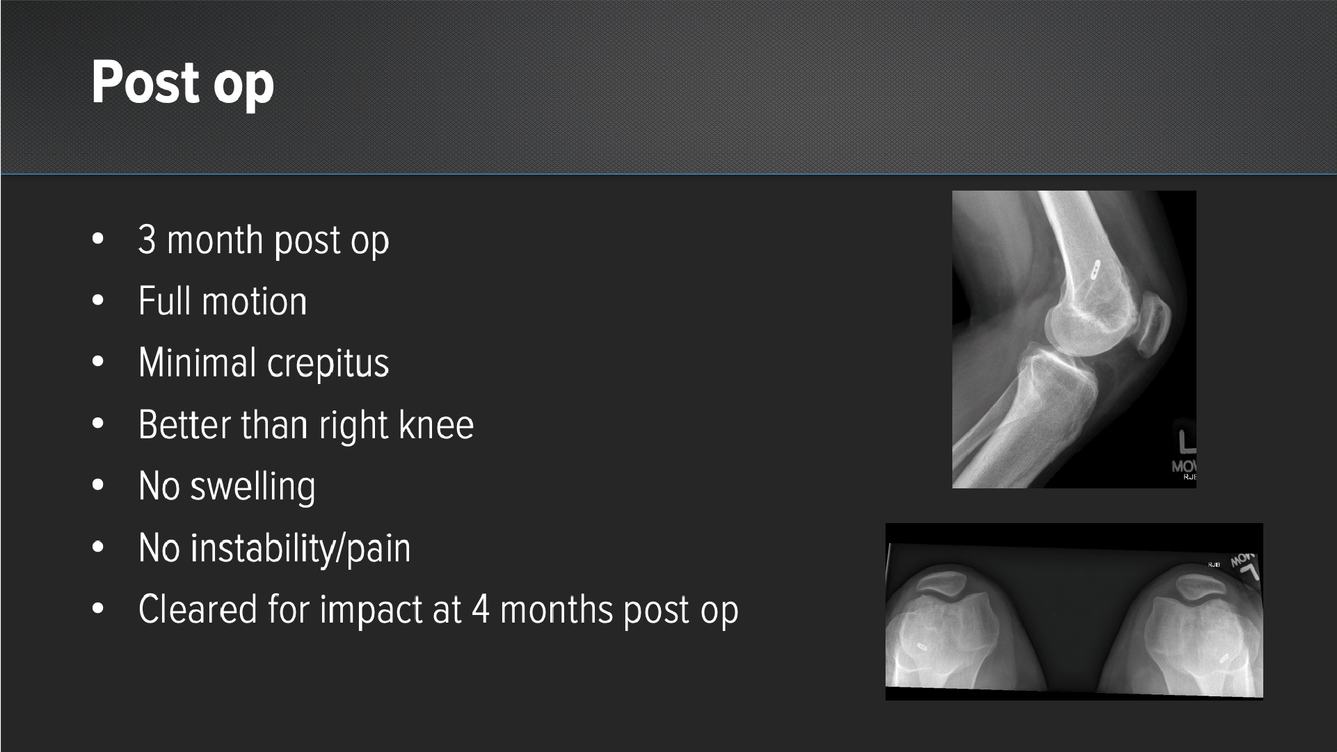 Complex Trochlear Cartilage Defect Repair With Cartiform® Viable Osteochondral Allograft
