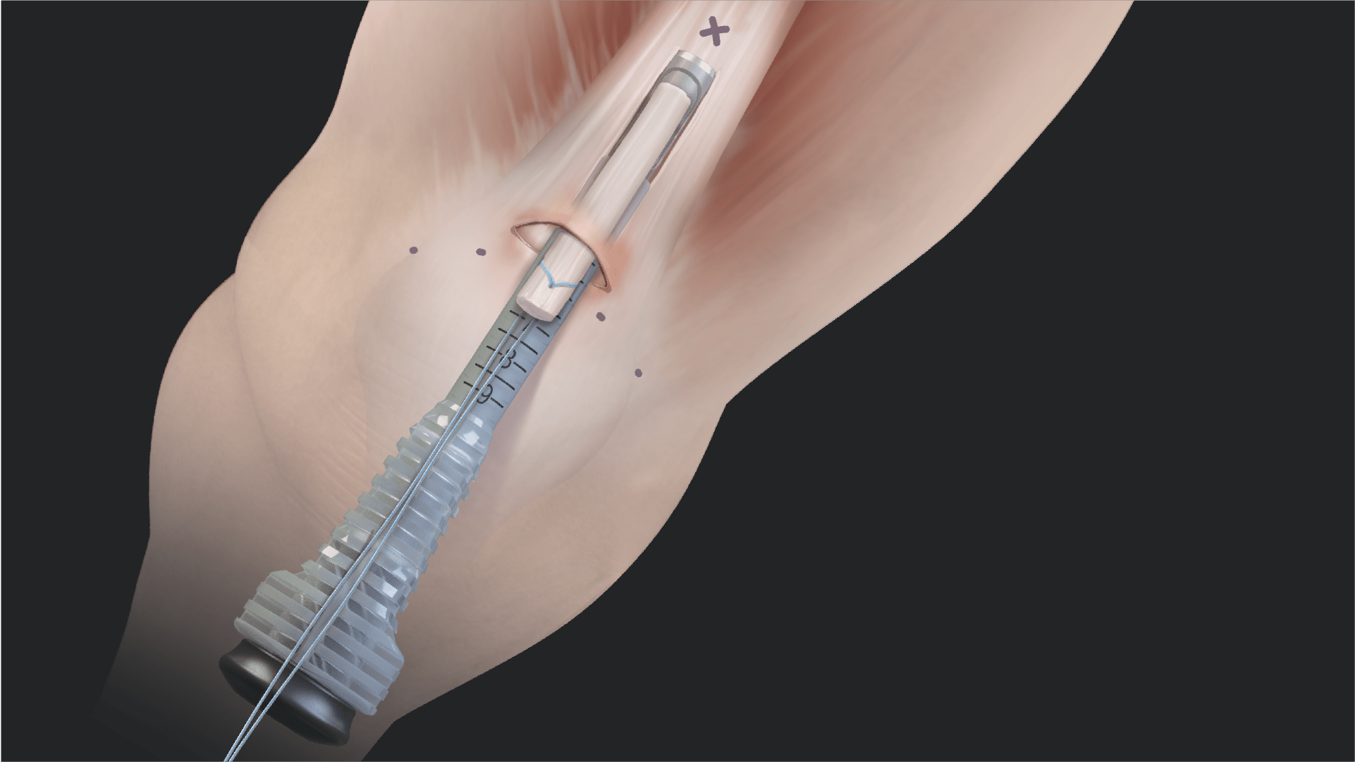 QuadLink™ ACL Reconstruction Using the QuadPro™ Harvester and FiberTag® TightRope® Implants