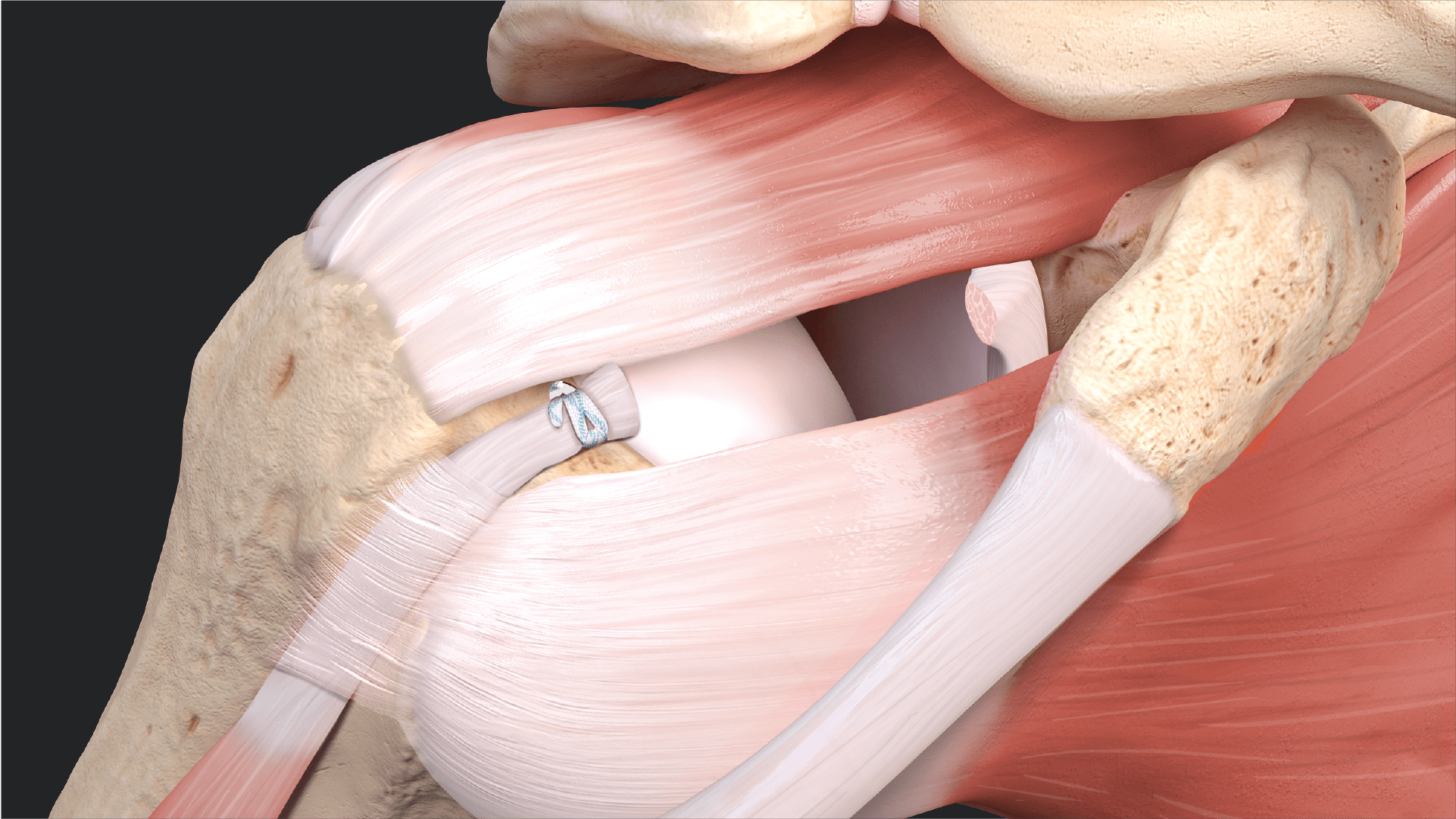 Loop 'N' Tack™ Biceps Tenodesis