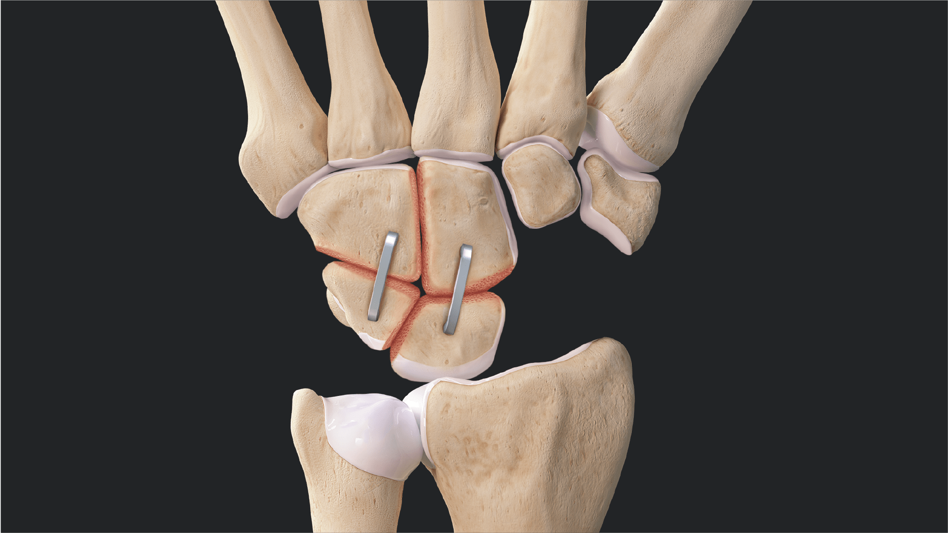 Four-Corner Fusion Fixation With DynaNite® Staples