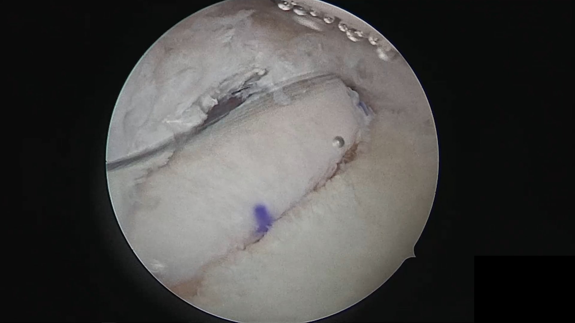 Arthroscopic Distal Tibia Allograft for Posterior Glenoid Reconstruction