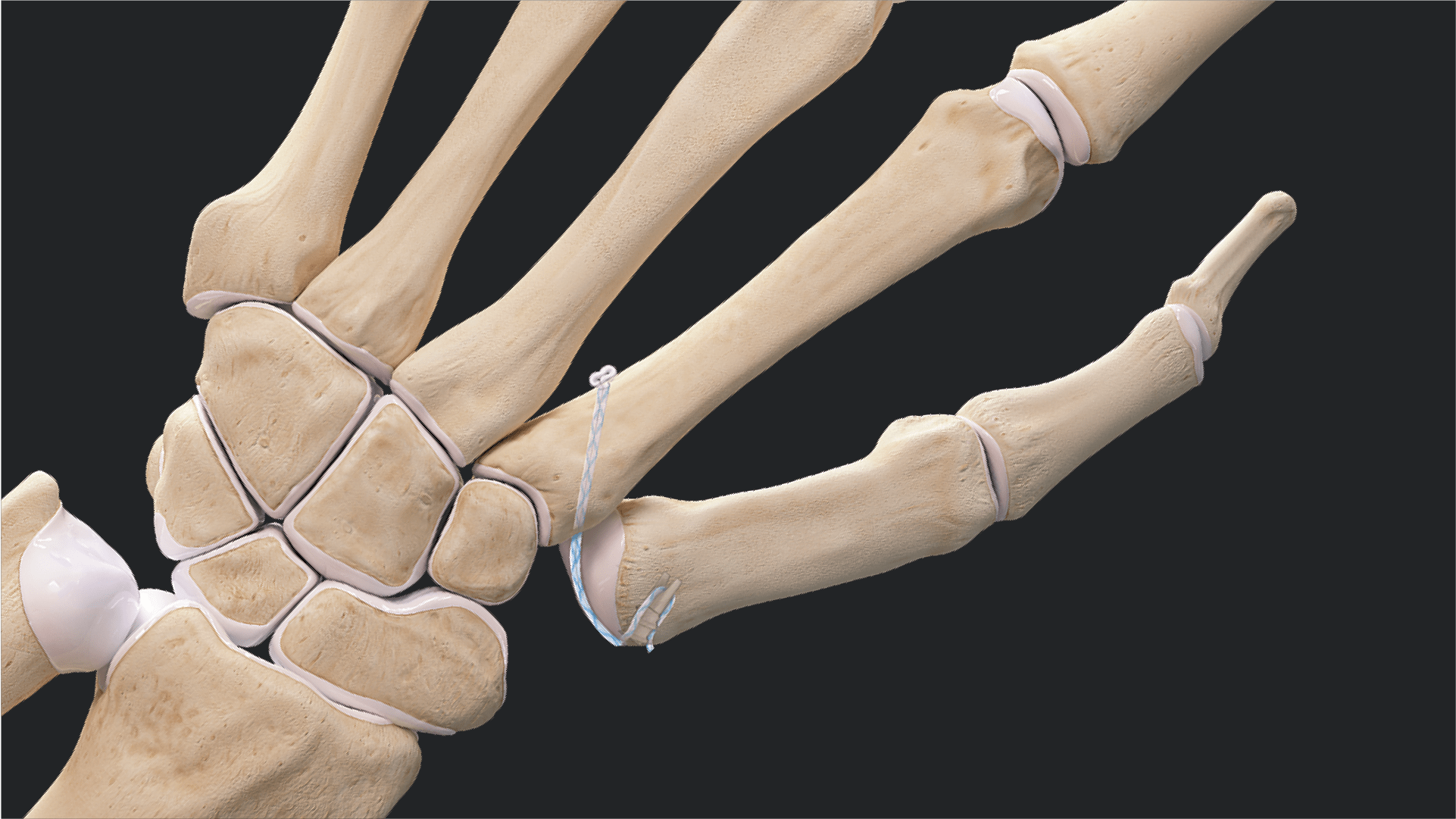 CMC Suspensionplasty With the FiberLock™ Suspension System