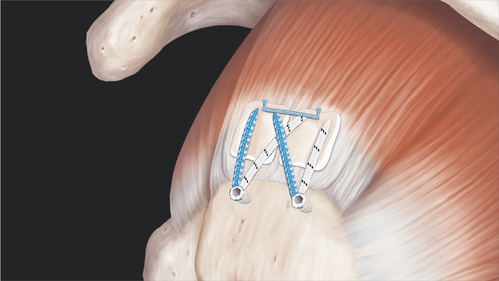 Rotator Cuff Repair With ArthroFLEX® BioWasher® Acellular Dermal Matrix