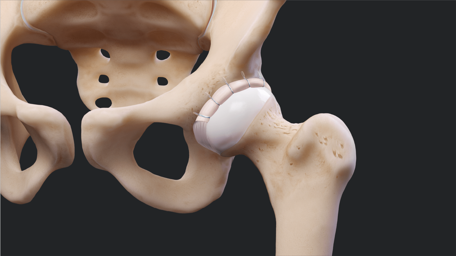 Acetabular Labral Reconstruction Using Precinched Loops From Knotless Hip FiberTak® Soft Anchors