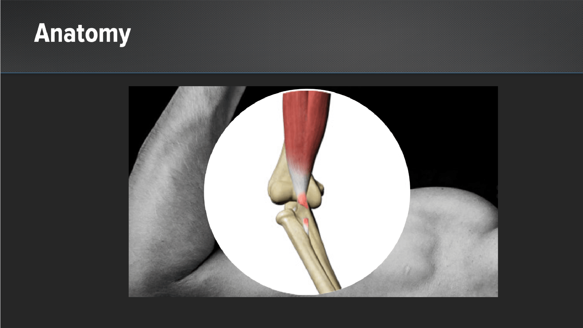 Two-Incision Distal Biceps Repair