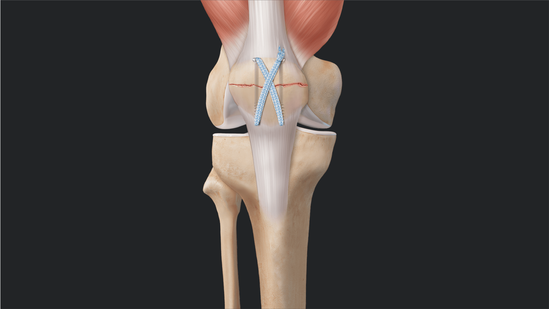 Patella Fracture Repair With FiberTape® Cerclage