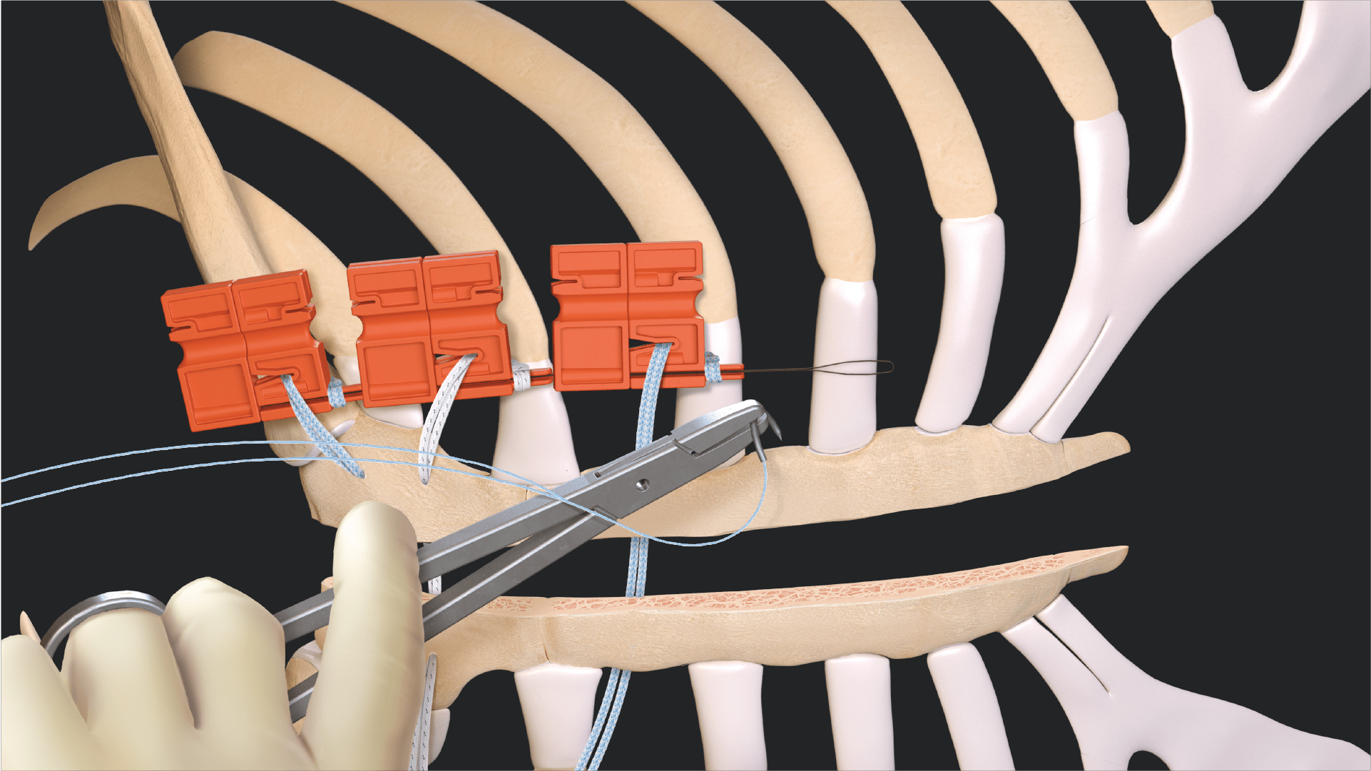 Median Sternotomy Closure With the FiberTape Sternal Closure System Featuring the Single-Use Tensioning Device