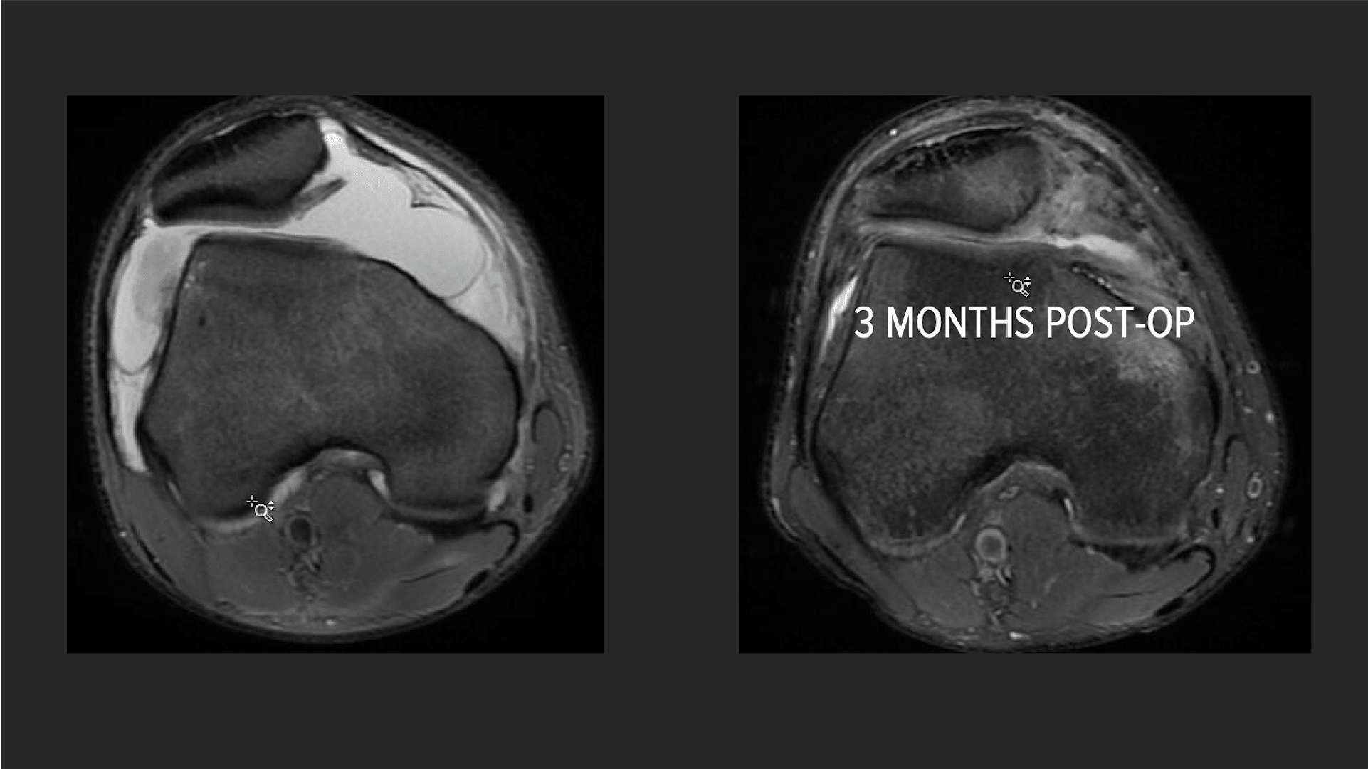 AutoCart™ Procedure in the Knee Using the GraftNet™ Device