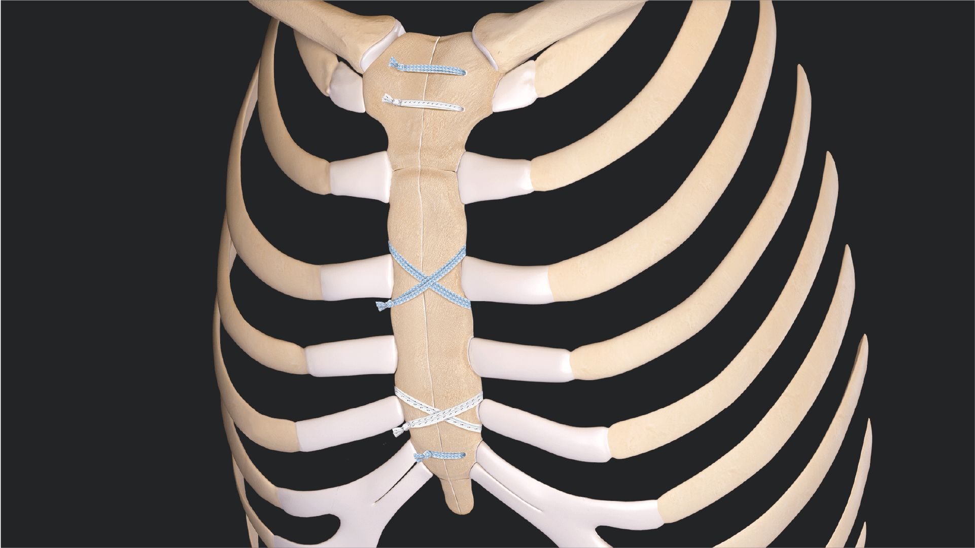 Median Sternotomy Closure With the FiberTape® Sternal Closure System