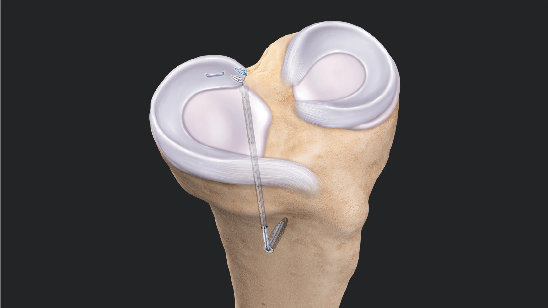 “Fix-and-Stitch” Augmented Posterior Meniscus Root Repair