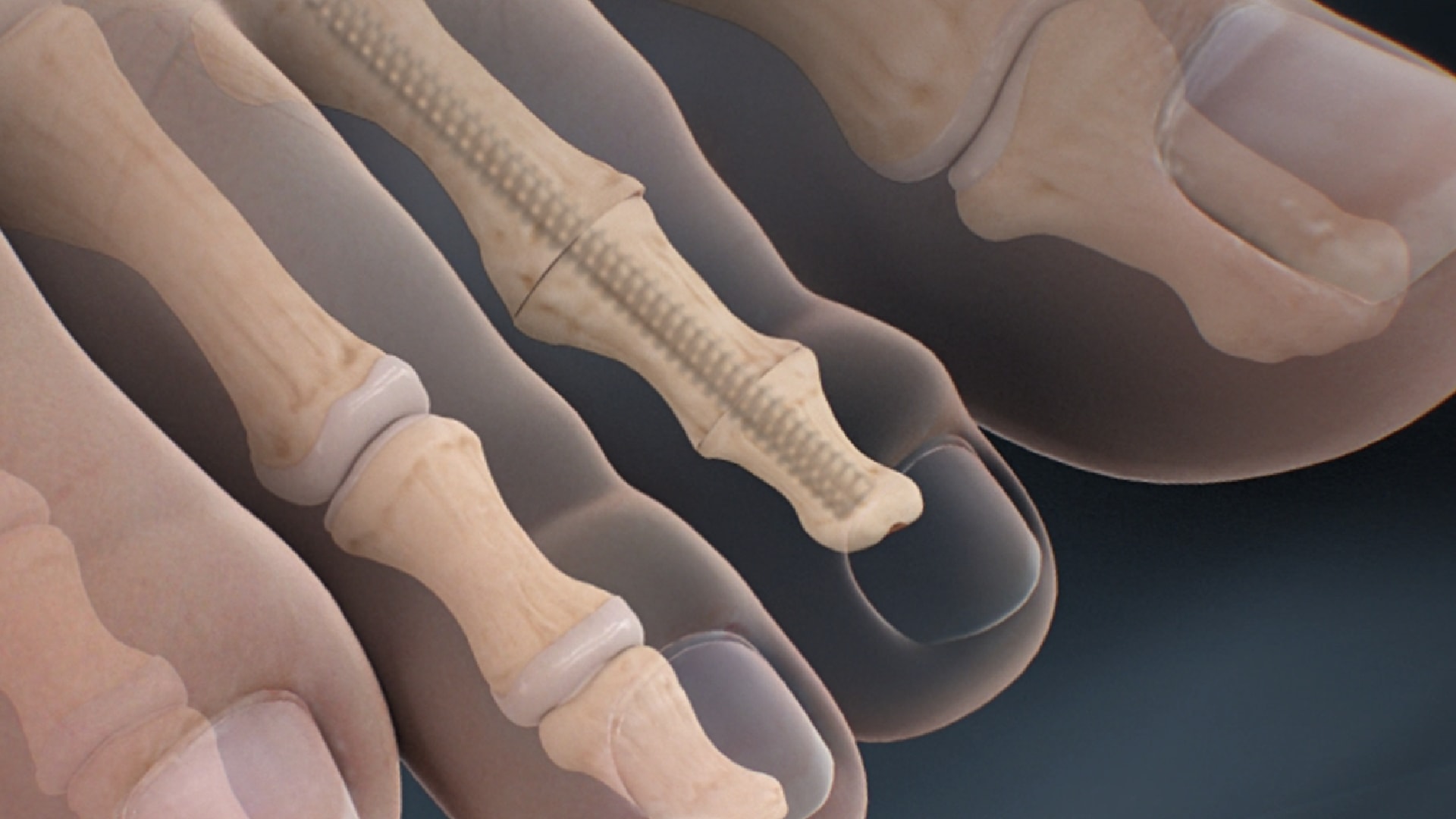 Minimally Invasive Hammertoe Correction — video thumbnail