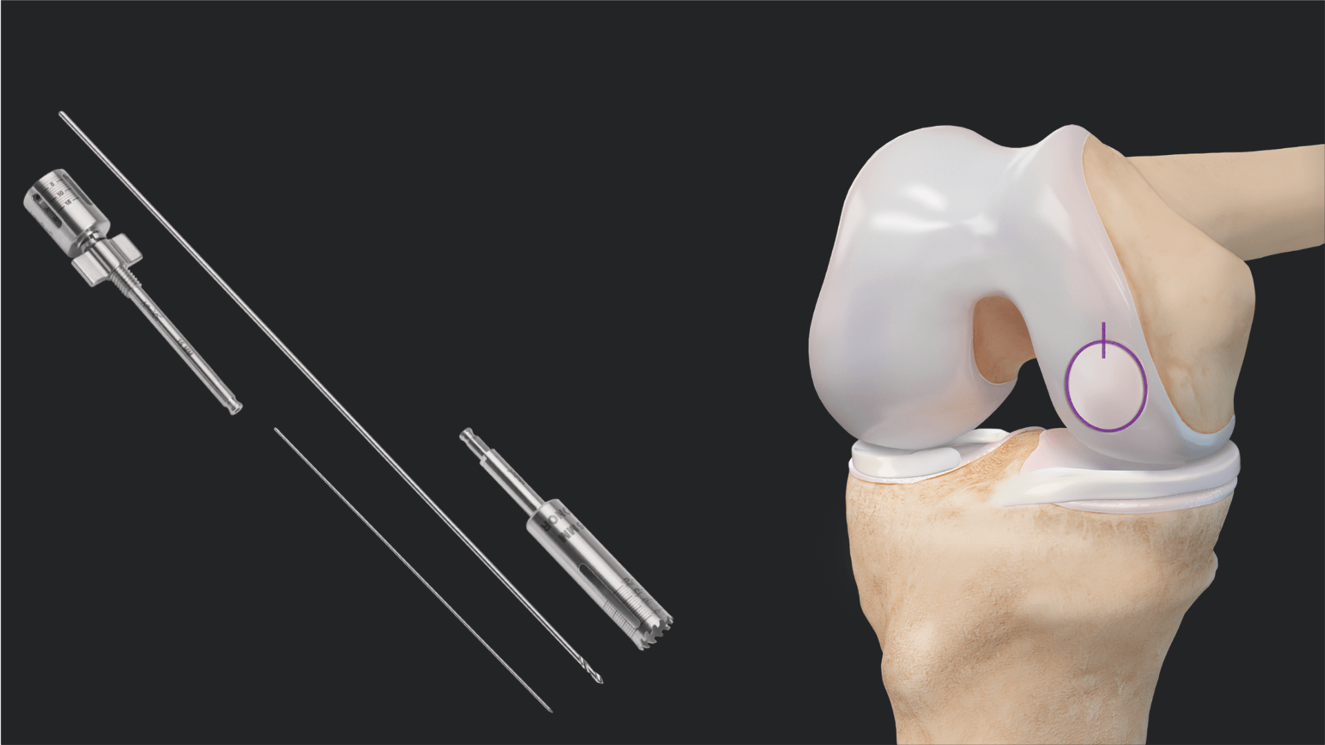 Arthrex - Treatment of a Femoral Condyle Cartilage Defect Using the ...