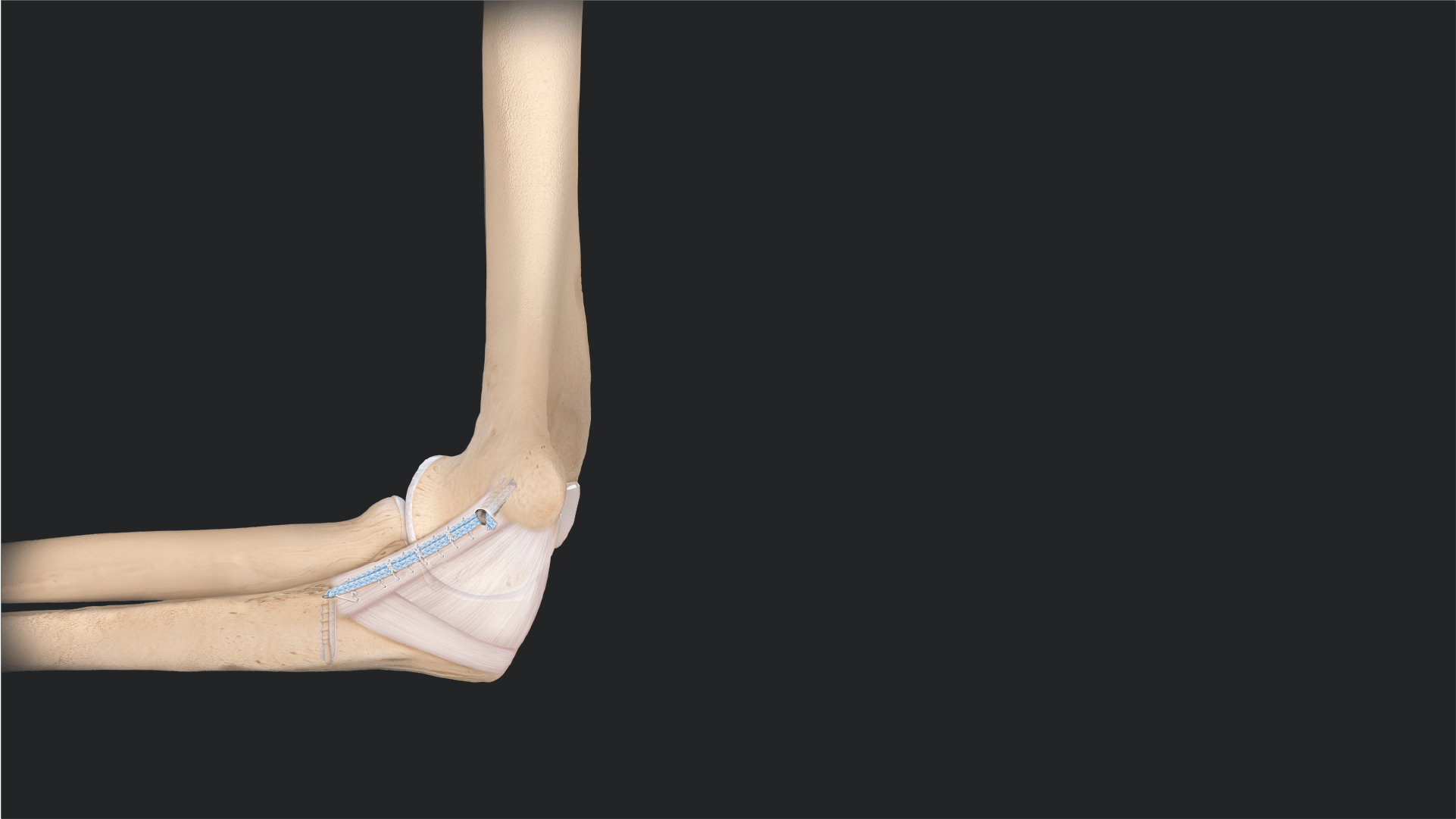 UCL Repair Using InternalBrace™ Ligament Augmentation Repair