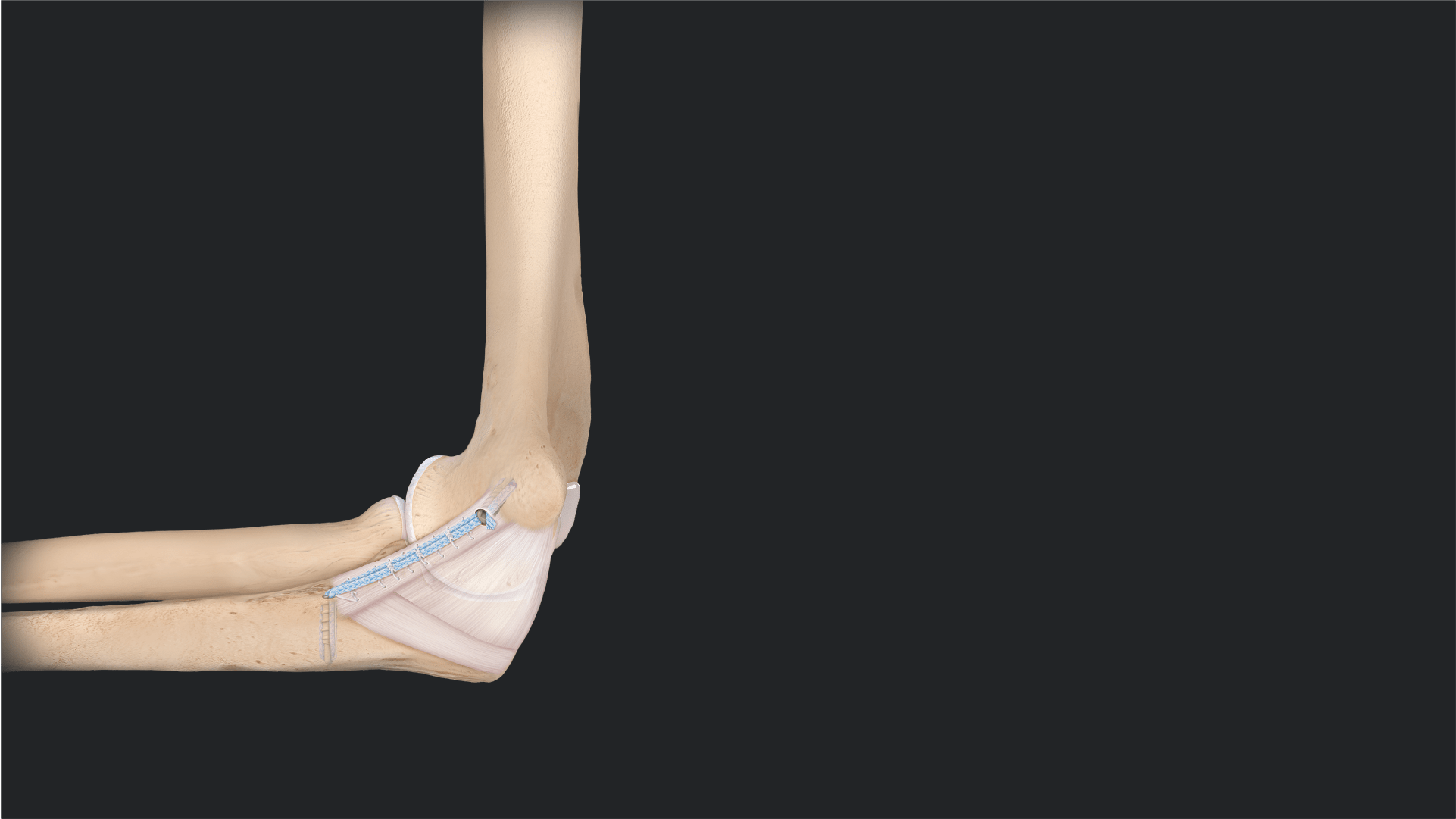Arthrex - UCL Repair Using InternalBrace™ Ligament Augmentation Repair