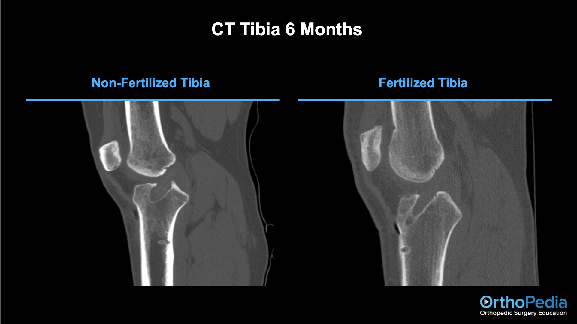 Improving Outcomes Through Biologic ACL Augmentation