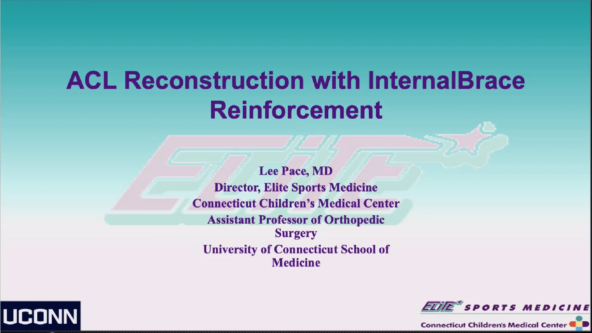 ACL Reconstruction Using the InternalBrace™ Technique