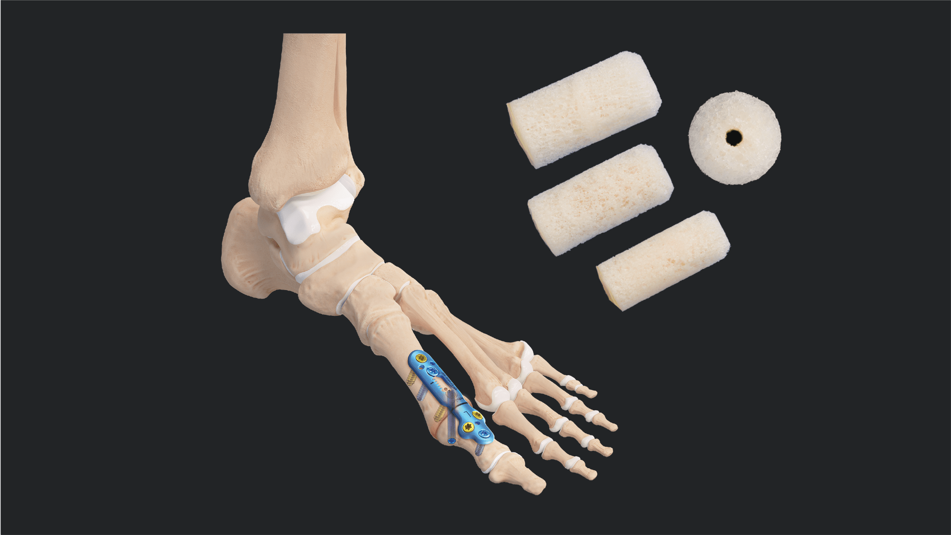 Arthrex 1st Mtp Revision Using A Cannulated Revision Bone Dowel And Arthrex 1st Mtp Revision Using A Cannulated Revision Bone Dowel And