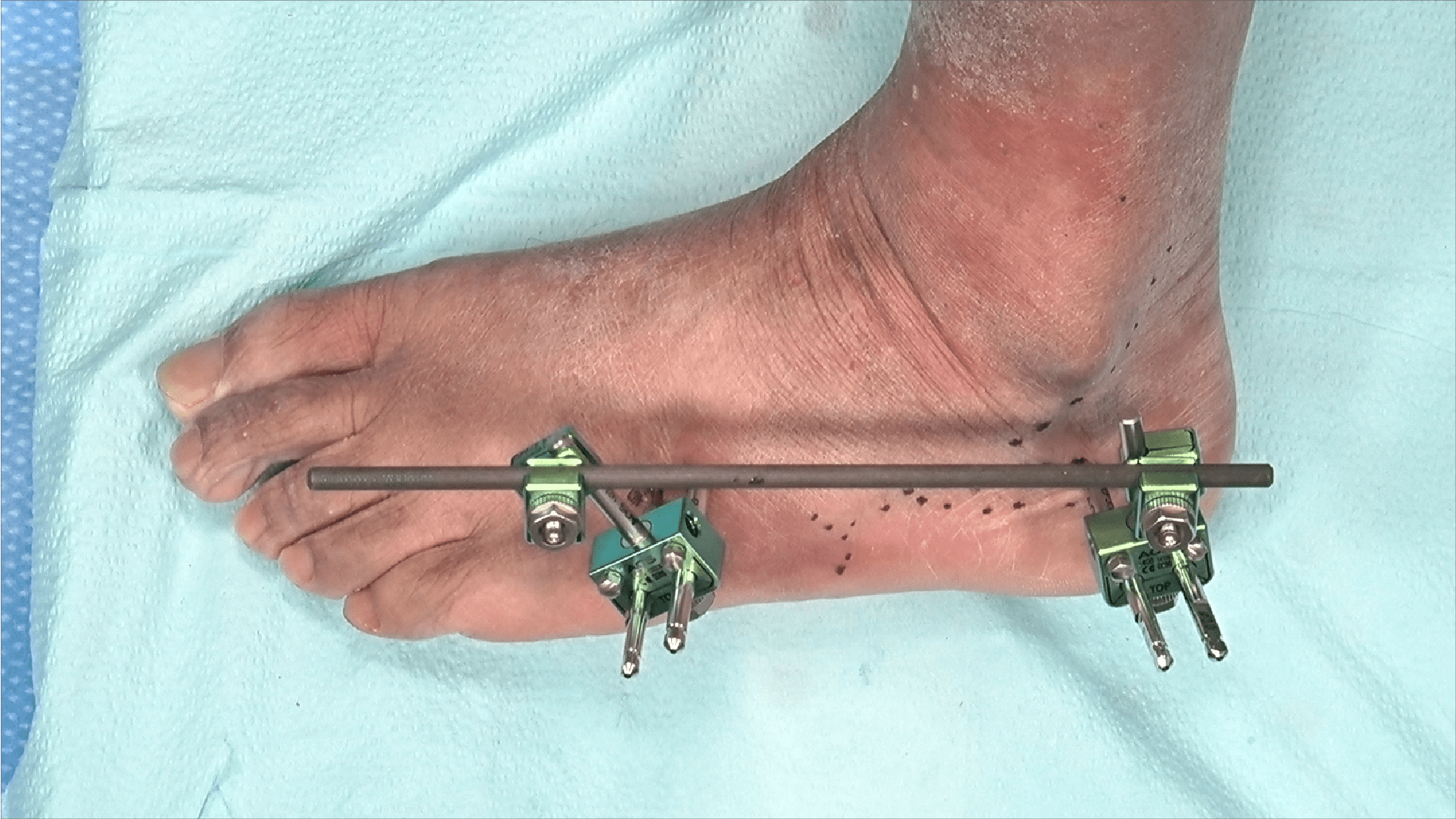 Lateral Column Lengthening With the Arthrex Small External Fixator System