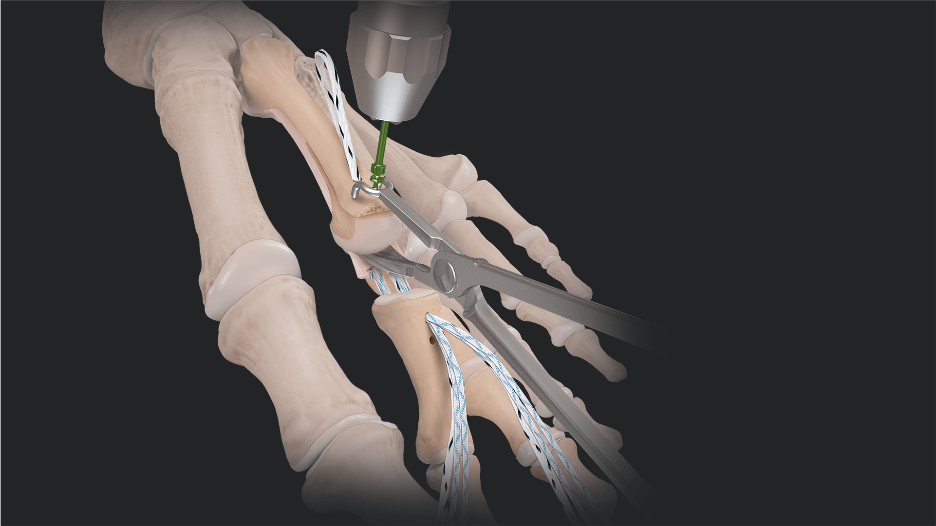 Continuum of Care: Plantar Plate Deformity