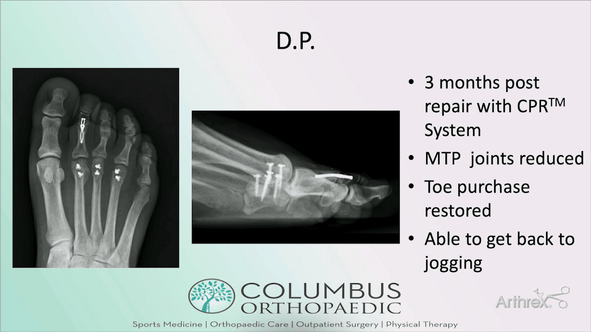 Clinical Consideration of Plantar Plate Repair: What Have We Learned?